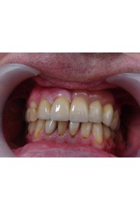 Po, 4 gingiva