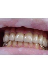 Po, 6 gingiva