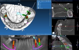 planowanie na podstawie badania CBCT 3D2
