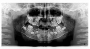 pantomogram dzieciecy