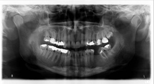 pantomogram