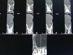 cbct 6x4 endo