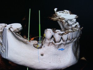cbct 6x8 jeden luk